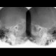 Schuller view, chronic mastoiditis: X-ray - Plain radiograph